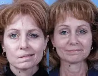 Bell's-palsy-before-after.webp