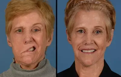 Bell's-palsy-before-after2.webp