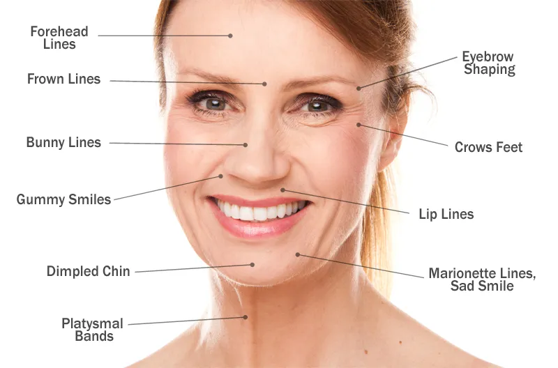 Botox-area.webp