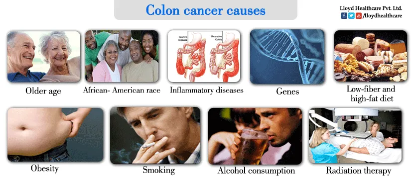 Colon-cancer-causes_2.webp