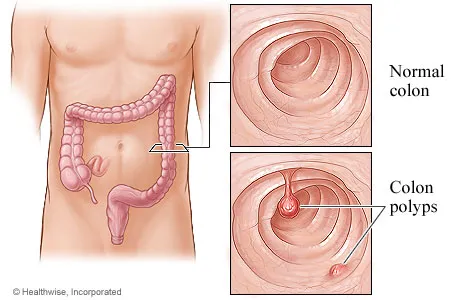 Colon-cancer.webp