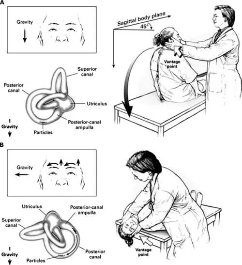 Dix-Hallpike-diagnosis.webp