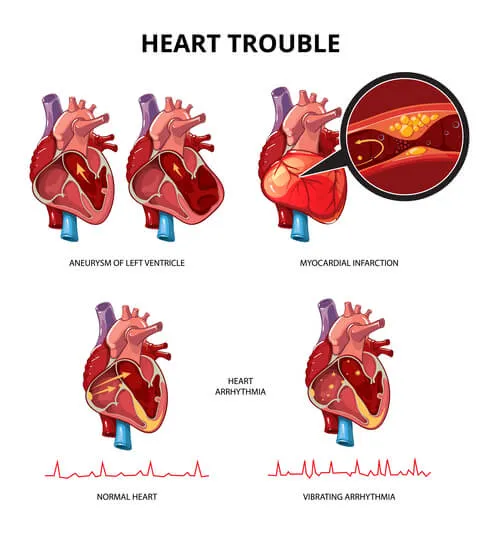 Heart-disease--infographics.webp