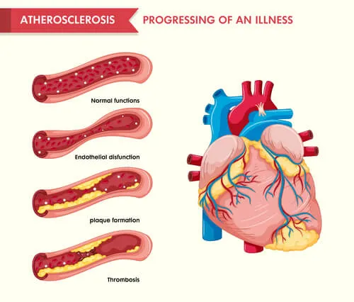 Heart-disease--infographics2.webp