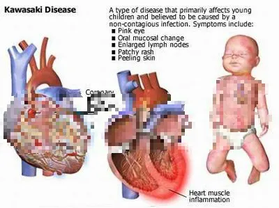 Kawasaki-disease.webp