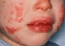 Kawasaki-disease_2.webp