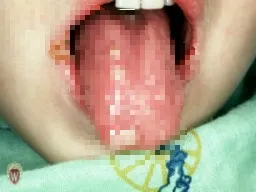 Kawasaki-disease_3.webp