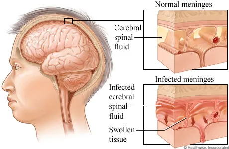 Meningitis.webp