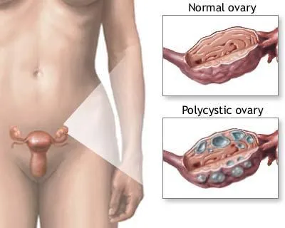 Polycystic-Ovarian-Syndrome.webp