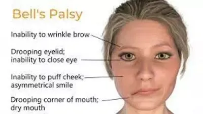 _Bell's-palsy.webp