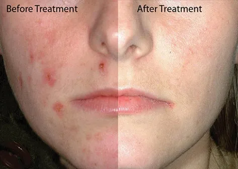 acne-face-after-before.webp