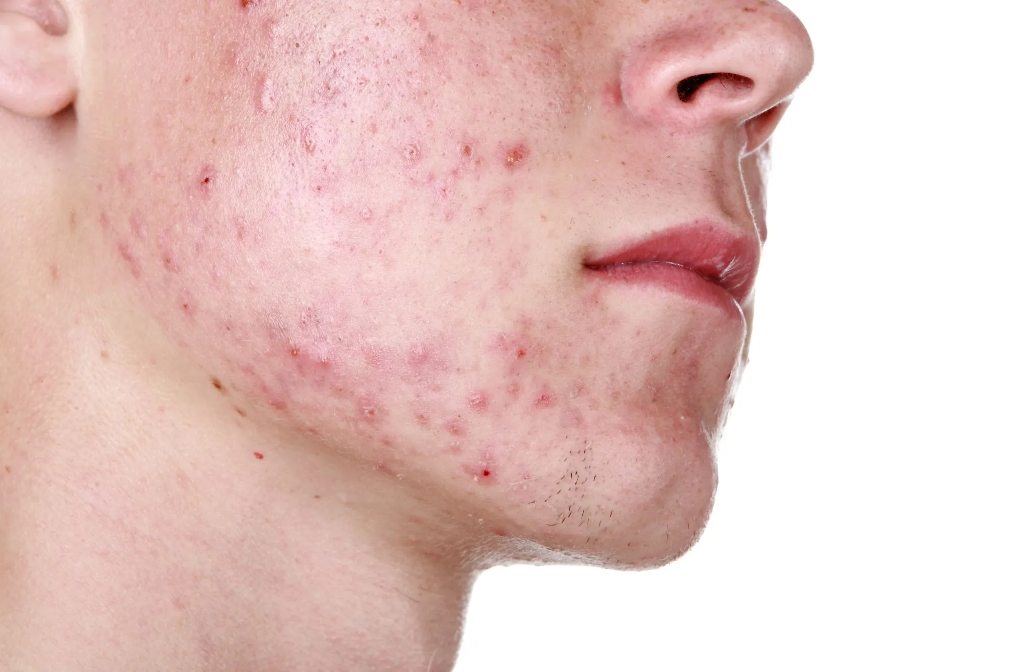 acne-face.webp