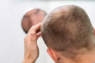 adult-male-having-balding-problems.webp