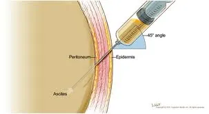 ascites-mechanism.webp