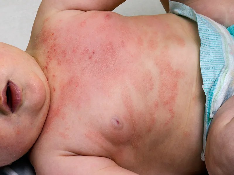 atopic-dermatitis-baby_2.webp