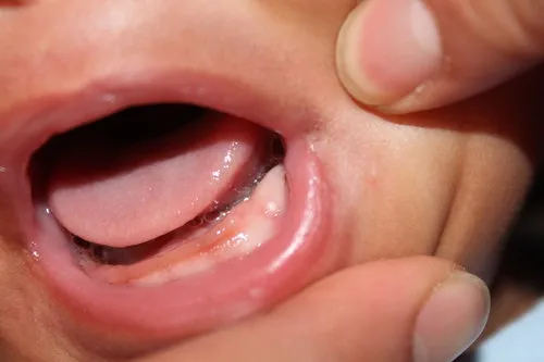 baby-stomatitis.webp