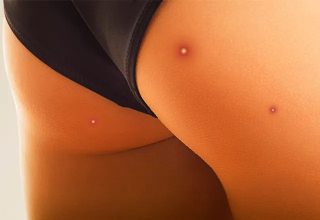 butt-acne.webp