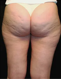 cellulite.webp