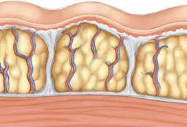 cellulite_4.webp