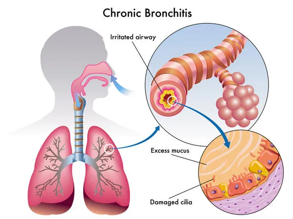 chronic-bronchitis.webp