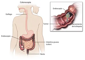 colitis_2.webp