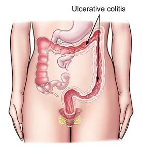 colitis_5.webp