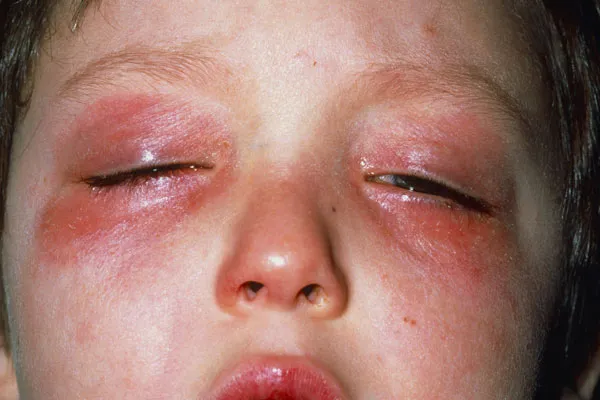 conjunctivitis.webp