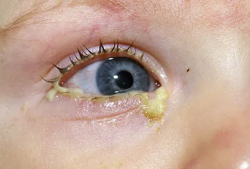 conjunctivitis_2.webp