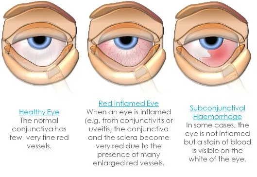 conjunctivitis_3.webp