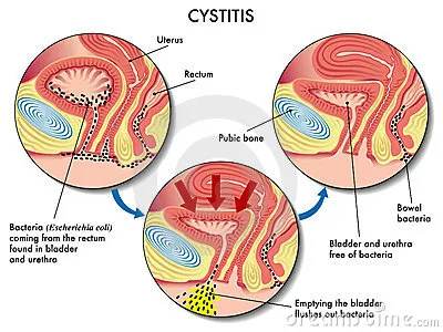 cystitis_6.webp