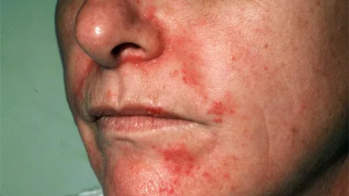 dermatitis-face.webp