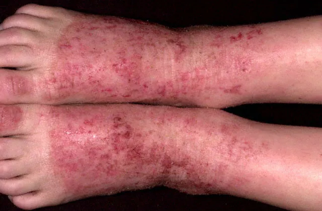 dermatitis-foots.webp