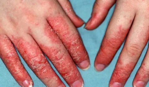 dermatitis-hand.webp