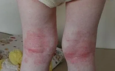 dermatitis-legs.webp