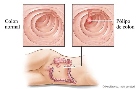 diarrhea-cancer.webp