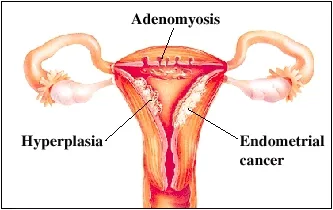 dysfunctional-uterine-bleeding.webp