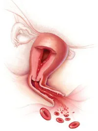 dysfunctional-uterine-bleeding_2.webp