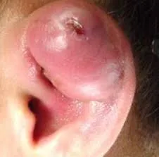 earlobe-big-pimple.webp