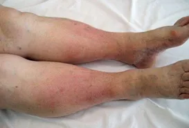 edema-legs.webp