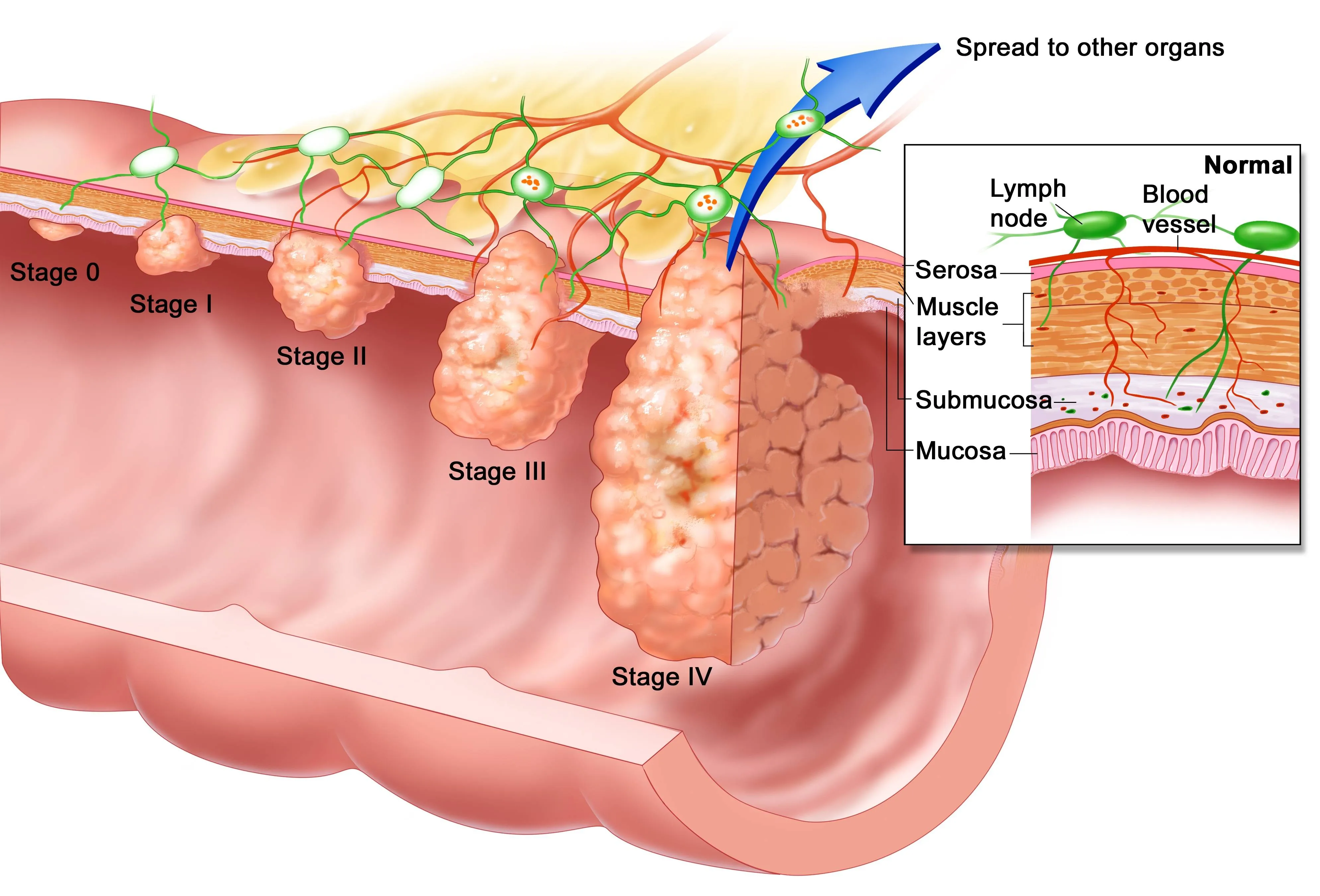 esophageal-cancer-inside.webp