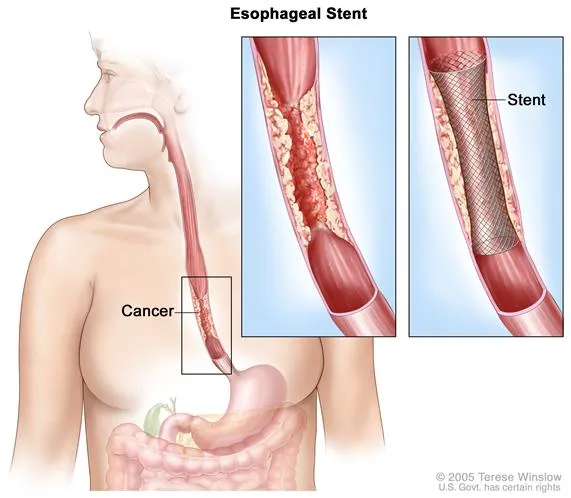 esophageal-cancer.webp