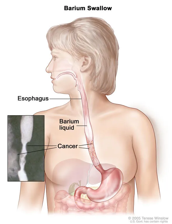 esophageal-cancer_3.webp