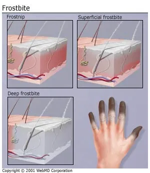 frostbite_2.webp