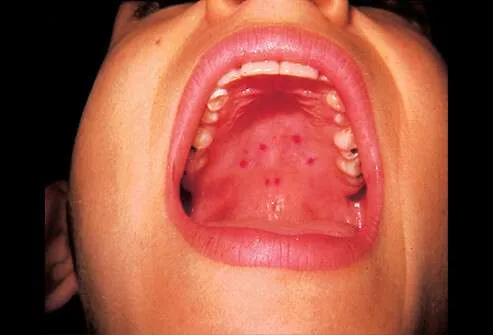 hand-foot-and-mouth-disease-mouth.webp