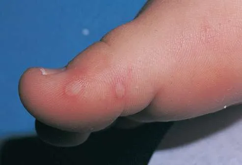 hand-foot-and-mouth-disease_2.webp