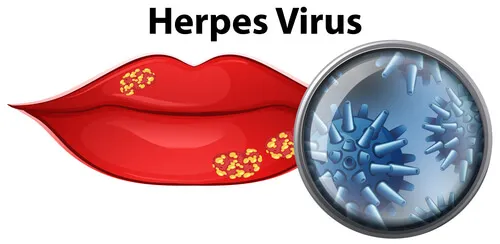 herpes-lip-virus.webp