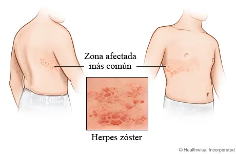 herpes-zoster_4.webp