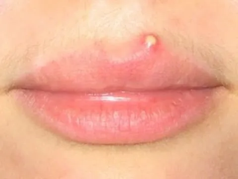 lip acne