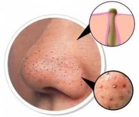 blackhead