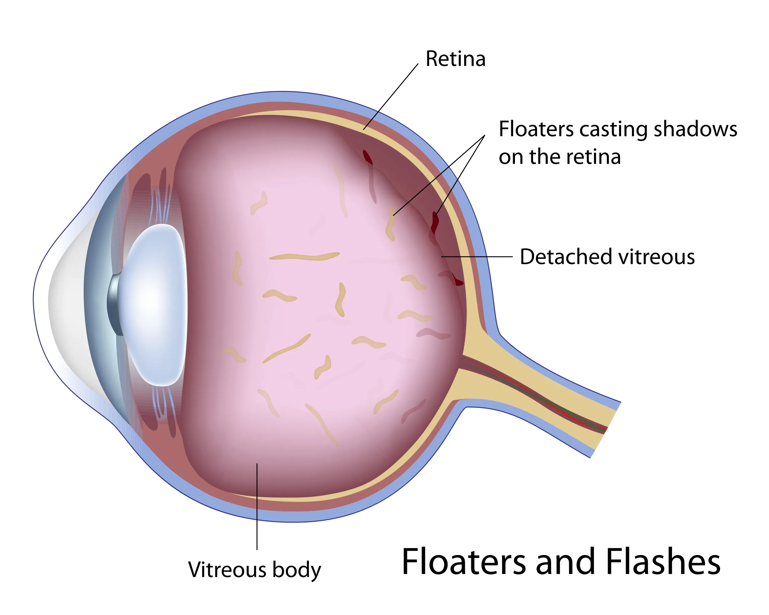 vitreous floaters